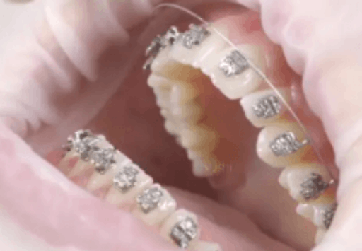 常用的牙种植体种类为（临*上主要采用的牙种植体为）